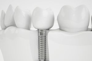 Dental-implant-grid