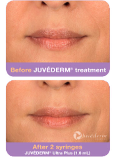 juvederm-3-before-after